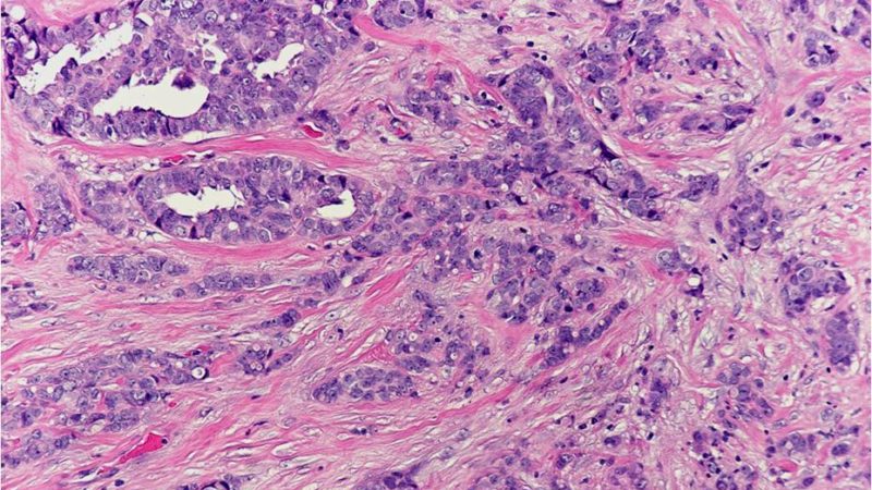 Invasive lobular carcinoma